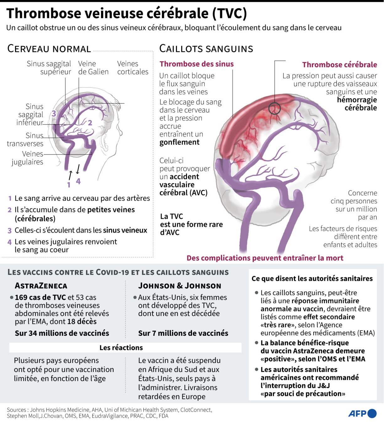Infographie sur la thrombose veineuse cérébrale, lorsqu'un caillot bloque l'afflux sanguin du cerveau ( AFP / Gal ROMA, Sophie RAMIS)