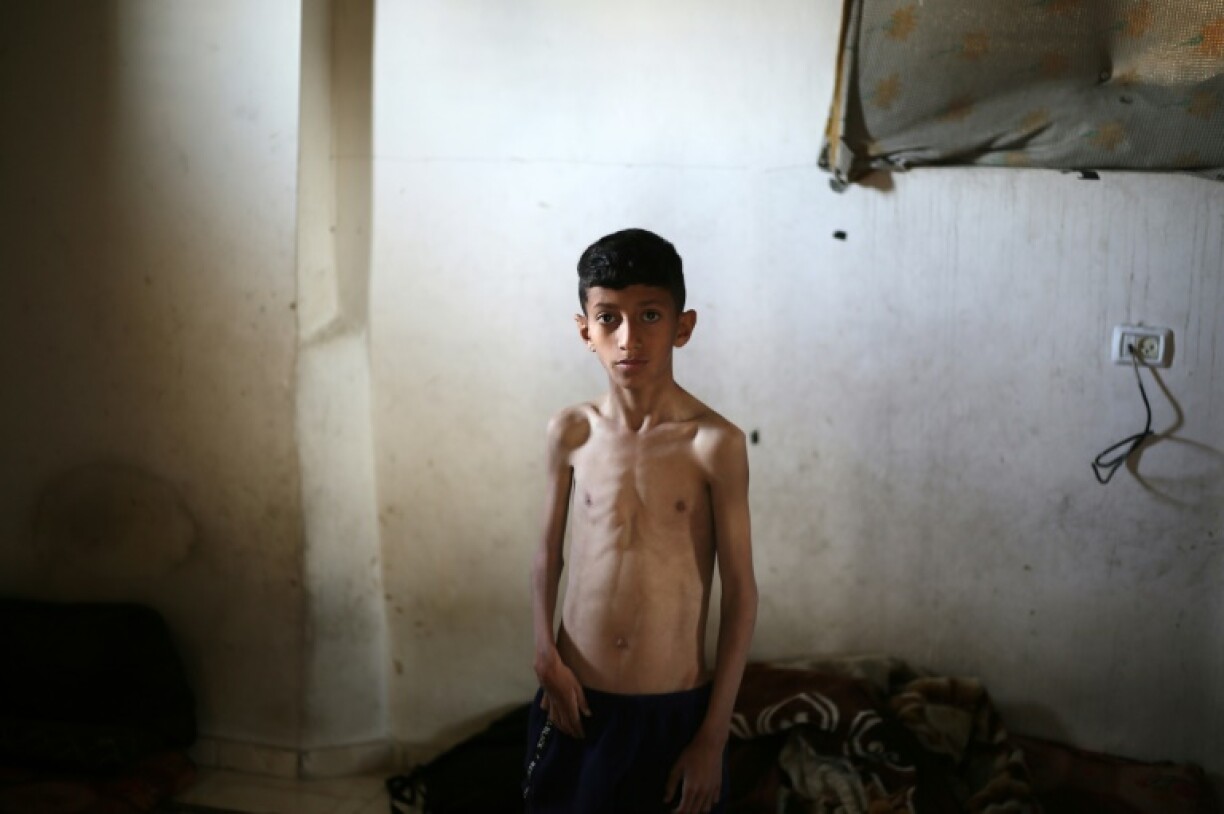 Mohammed Hanieh, a 13-year-old Palestinian who his family says suffers from malnutrition, pictured at the family home in central Gaza