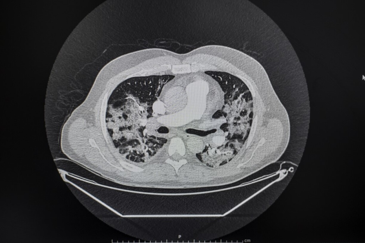 Scan of an infected person's brain: Covid-19
