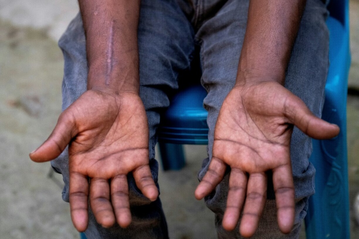Shipbreaker Mizan Hossain, whose back was crushed in a 10-metre fall, showing his swollen hands