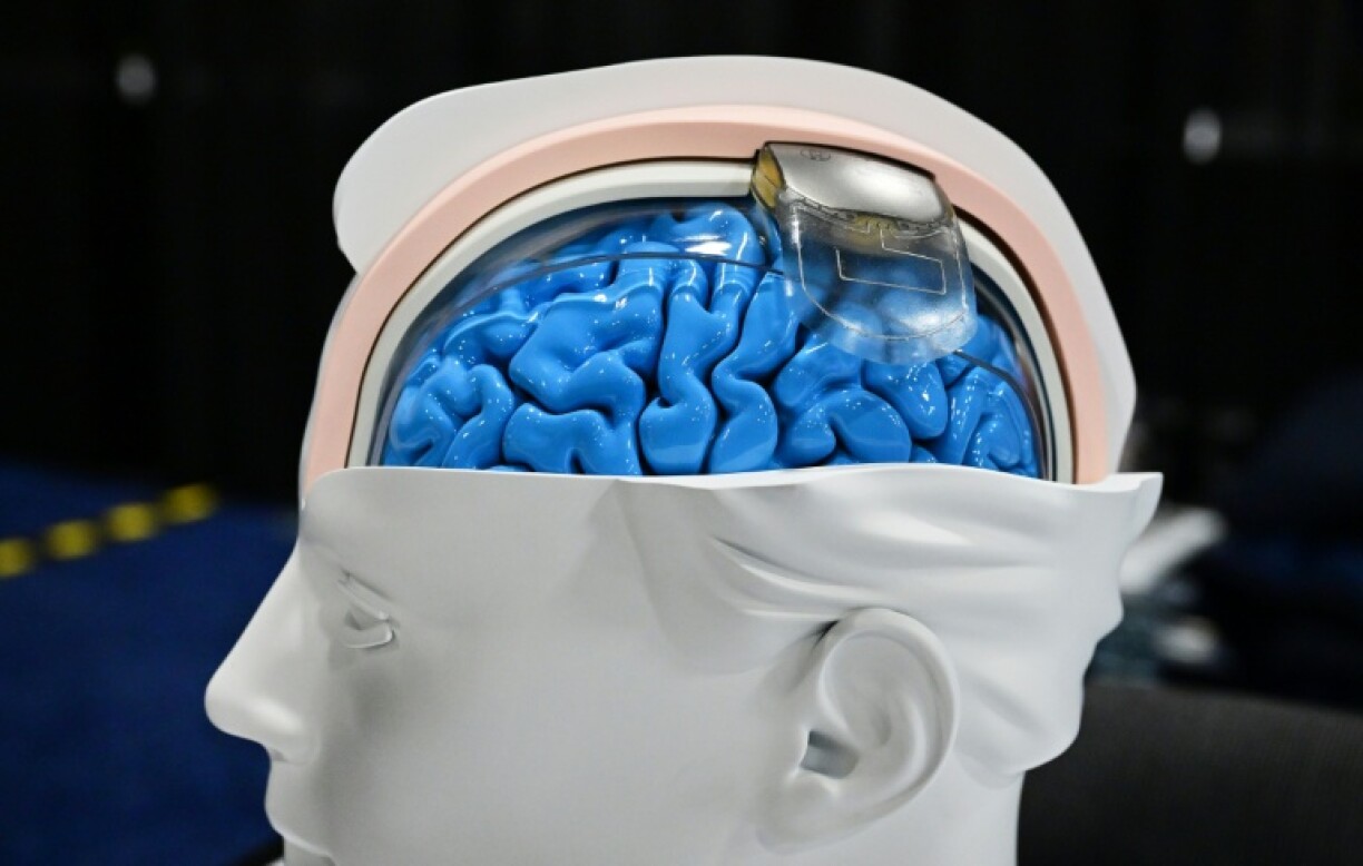 Are brain implants the tech of the future? Some think neurotech could be as revolutionary as AI
