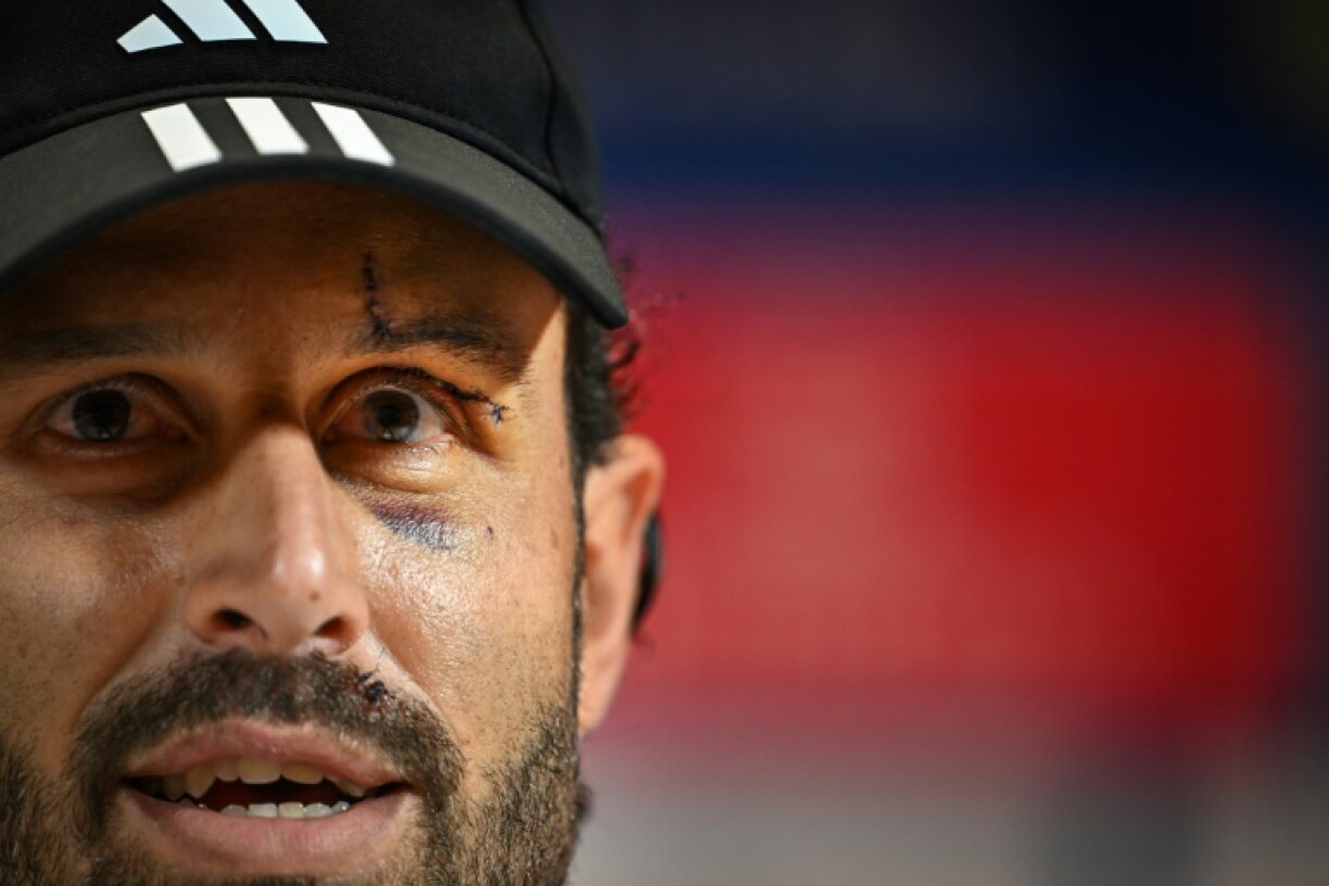 Fabio Grosso, le visage portant les stigmates de sa grave blessure lors du caillassage du car lyonnais à Marseille, lors d'une conférence de presse au Groupama Stadium le 3 novembre 2023