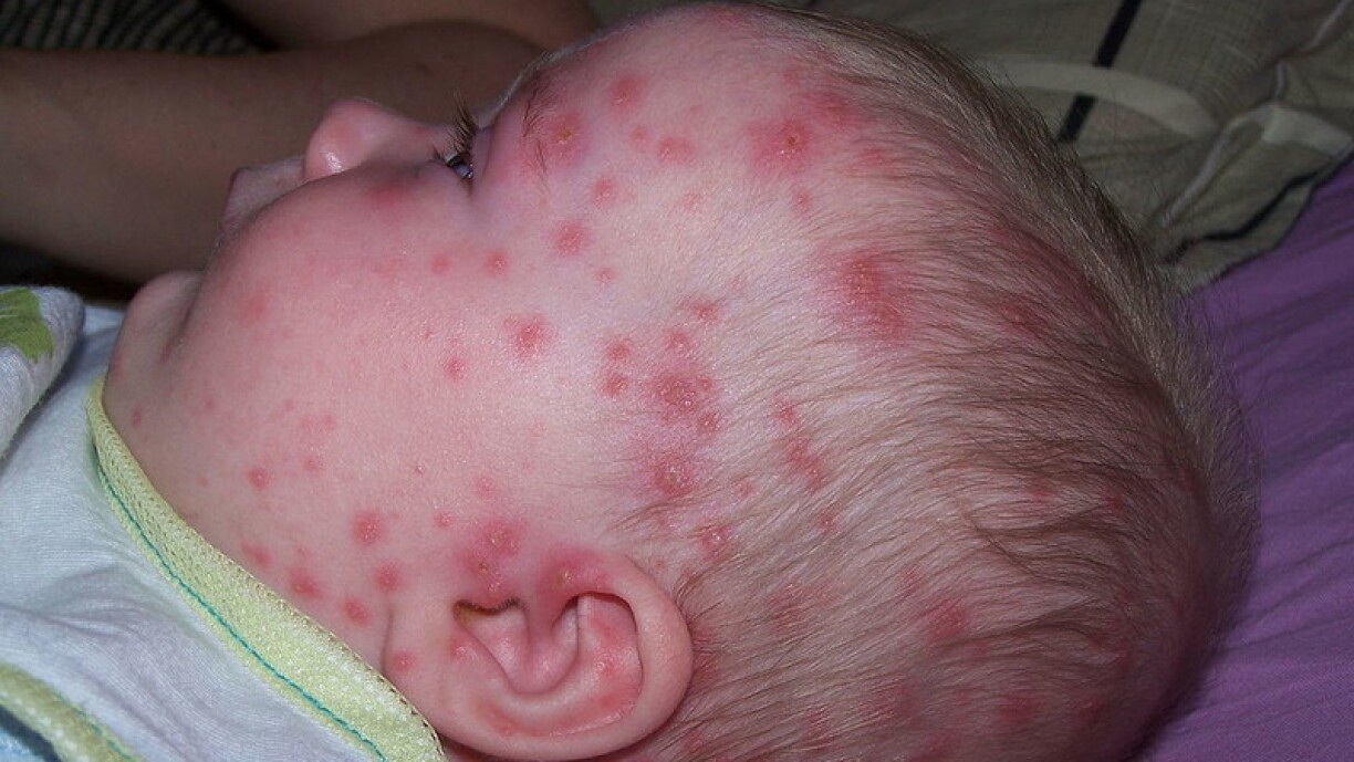 Photo d'illustration - Le Grand Est fait partie des 12 foyers régionaux d'