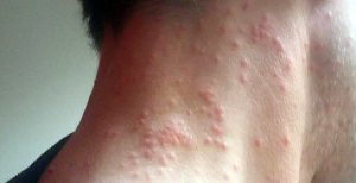 Allergic reaction to the caterpillar hairs