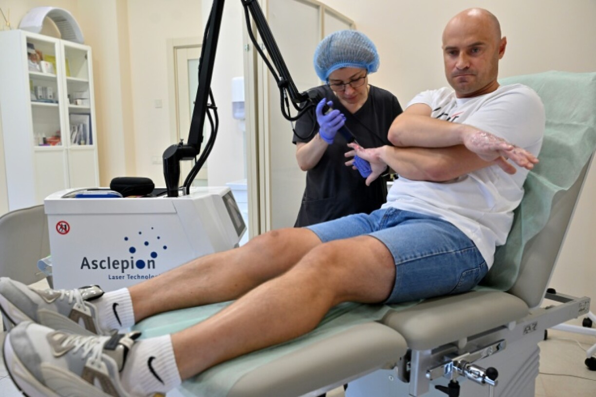 La dermatologue Kateryna Bezverchenko (g) soigne au laser Felix Rasko, volontaire engagé dans l'armée ukrainienne, aux mains brûlées, dans la clinique Choupeniouk à Kiev, le 25 juillet 2023