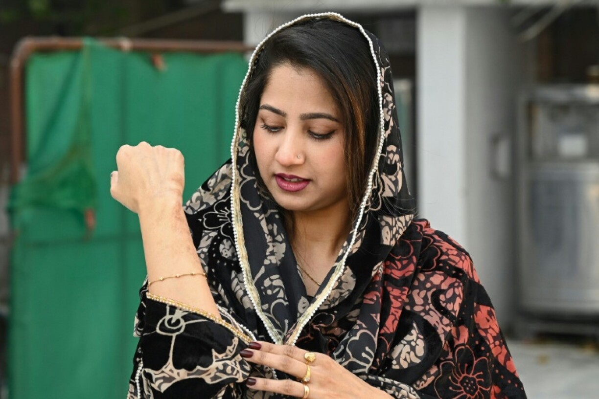 Natasha Zulfiqar, femme au foyer blessée avec ses parents dans un attentat meurtrier, montre les cicatrices sur son poignet droit lors d'un entretien avec l'AFP à l'occasion de Noël, à l'église All Saints de Peshawar, le 25 décembre 2025 au Pakistan