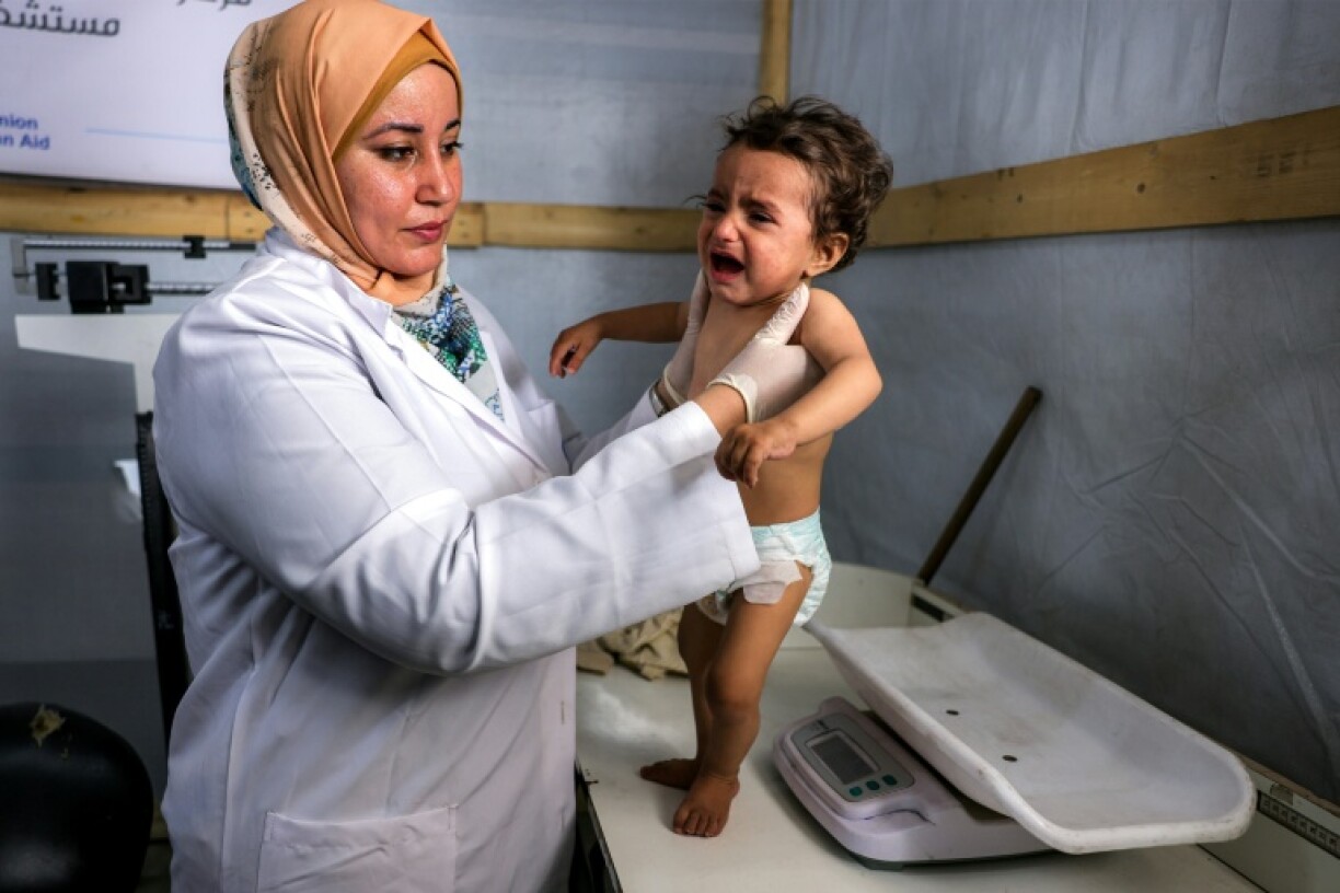 Nujud Suleiman, a one-year-old Palestinian infant suffering from malnutrition, is measured during treatment at Kamal Adwan Hospital in Beit Lahia, northern Gaza