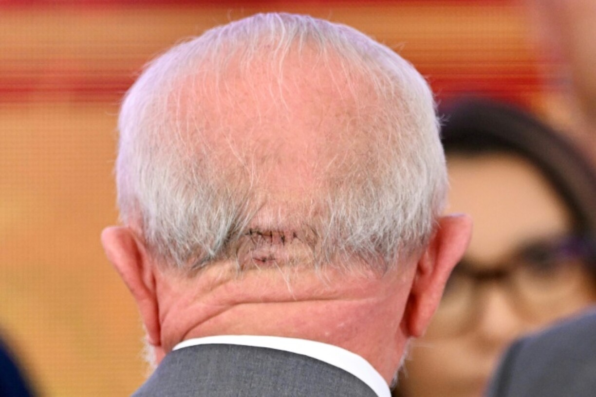 Imagen de una herida en la cabeza del presidente brasileño, Luiz Inácio Lula da Silva, tomada durante una ceremonia en el Palacio de Planalto, en Brasilia, el 25 de octubre de 2024.