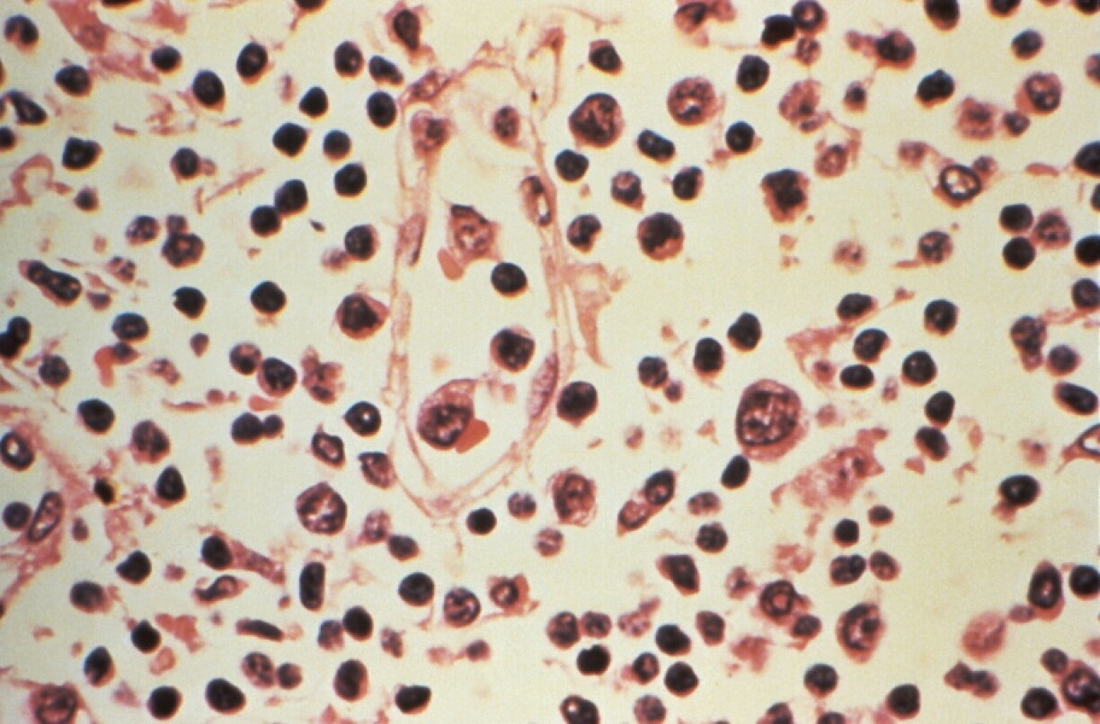 Photo non datée, obtenue le 6 mai 2026 des Centres américains de contrôle et de prévention des maladies (CDC), montrant au microscope des détails histopathologiques d'un prélèvement de ganglion lymphatique effectué chez un patient suspecté d'être atteint d'une infection à hantavirus