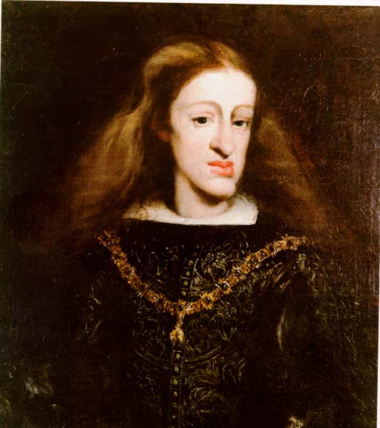 Charles II of Spain, the last Spanish Habsburg ruler of Luxembourg, with his Habsburg jaw.